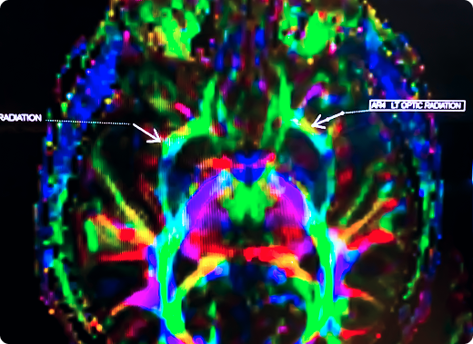 Nuclear Medicine Content Una imagen colorida del cerebro de un paciente obtenida mediante una exploración de medicina nuclear